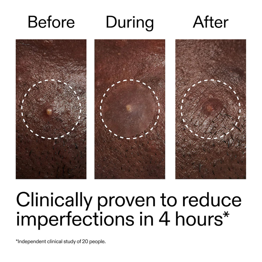 Invisible Acne Patch pack of 36